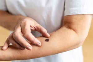 high-angle-hand-measuring-mole_23-2149359544